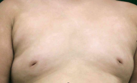 Pityriasis alba on body