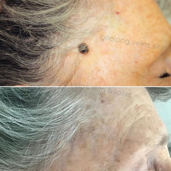 Mole & Brown Spot Removal by Geelong Veins Skin & Laser