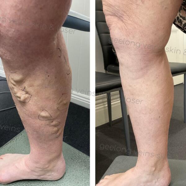 Varicose Vein Treatment