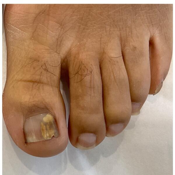 Fungal Nail Treatment