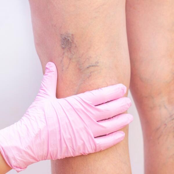 Spider & Surface Vein Treatment