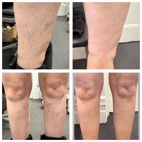 Spider & Surface Vein Treatment