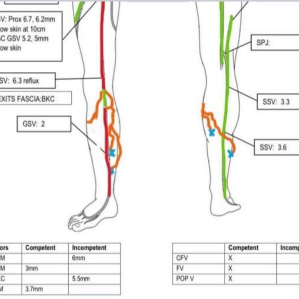 Varicose Vein Treatment