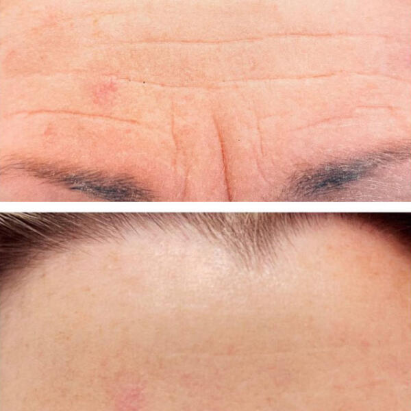 Before and after aging skin treatment by Geelong Veins Skin & Laser