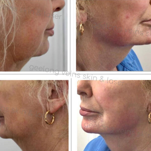 Jaw and chin shaping by Geelong Veins Skin & Laser