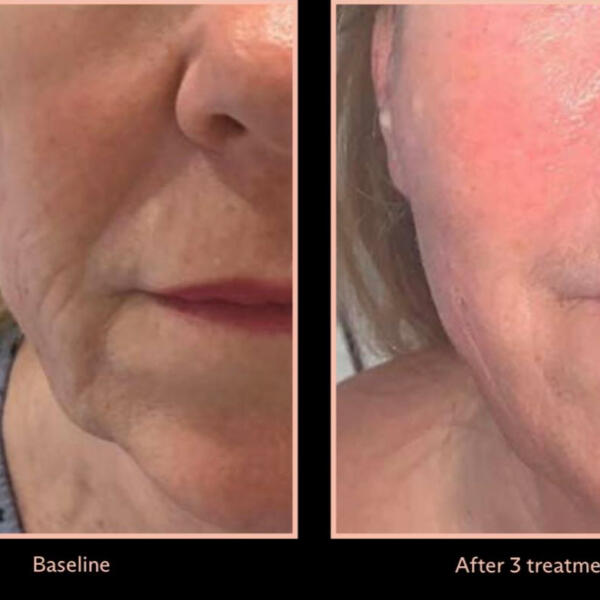 Jaw and chin shaping by Geelong Veins Skin & Laser