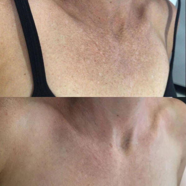 Laser pigmentation treatment by Geelong Veins Skin & Laser