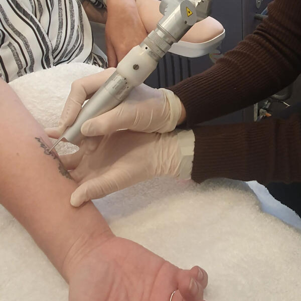 Laser tattoo removal by Geelong Veins Skin & Laser