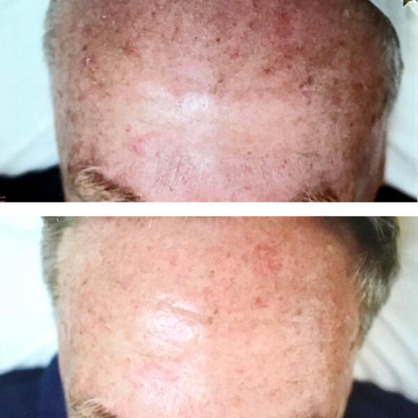 Photodynamic therapy by Geelong Veins Skin & Laser