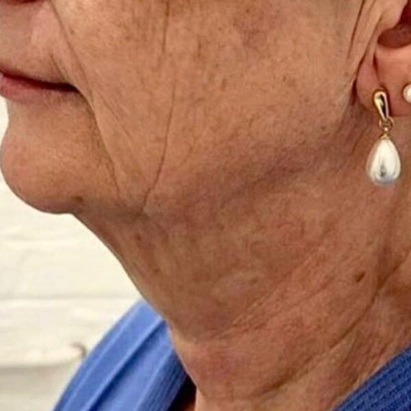 Before radiofrequency microneedling