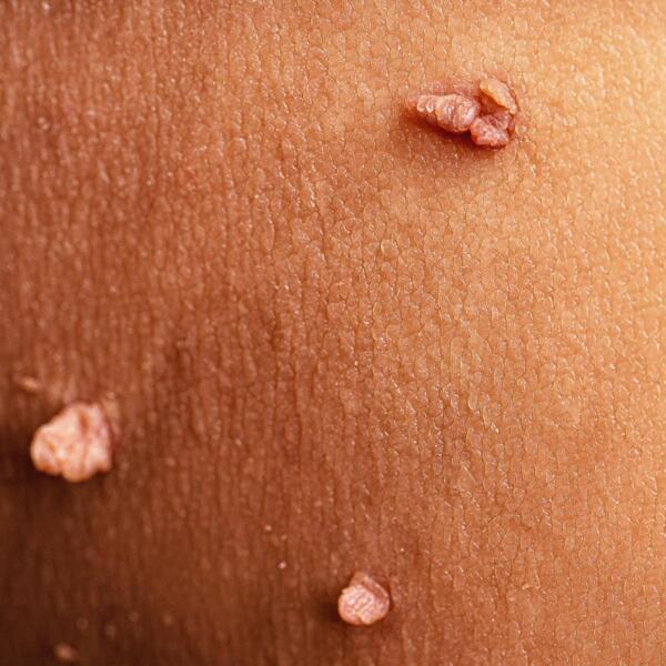 Skin tags can be removed by Geelong Veins Skin Laser