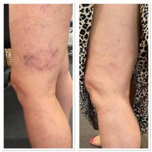 Spider Vein Before And After treatment 